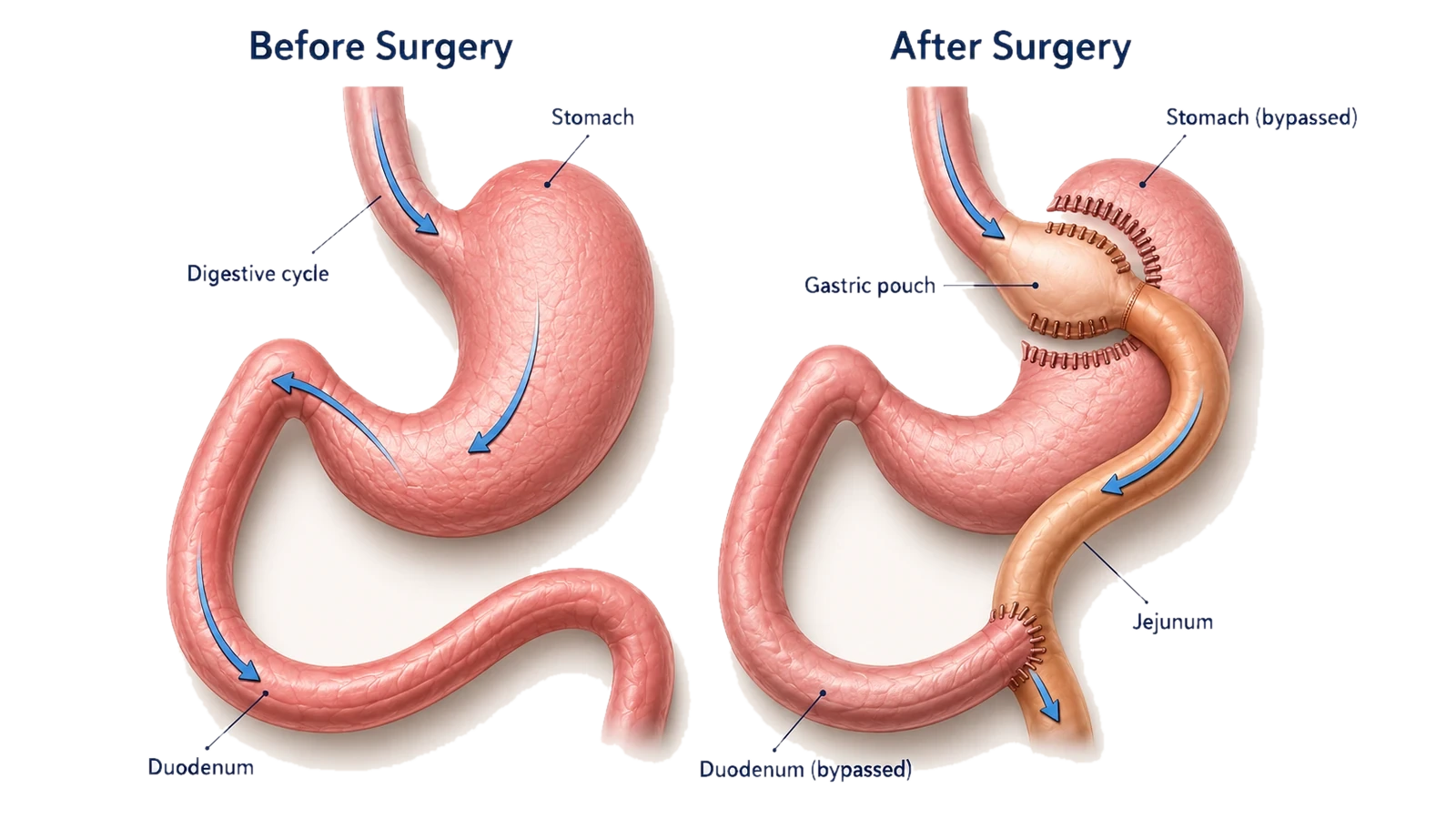 Roux-en-Y gastric bypass anatomy