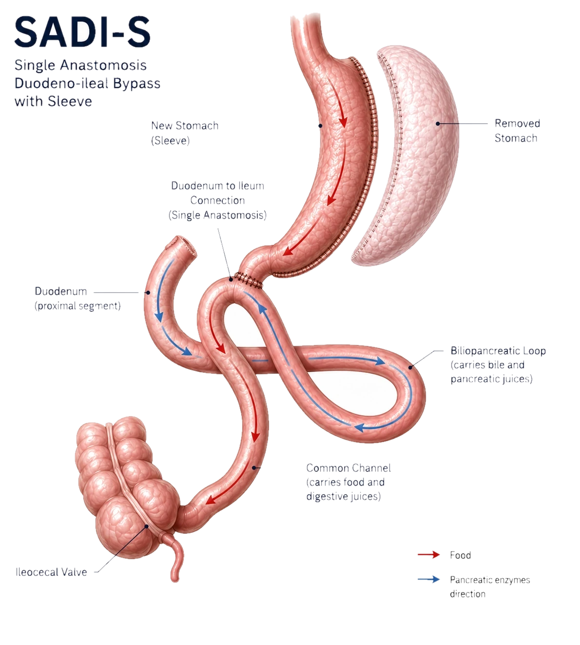 SADI-S anatomy: a gastric sleeve with a single duodenum-to-ileum connection