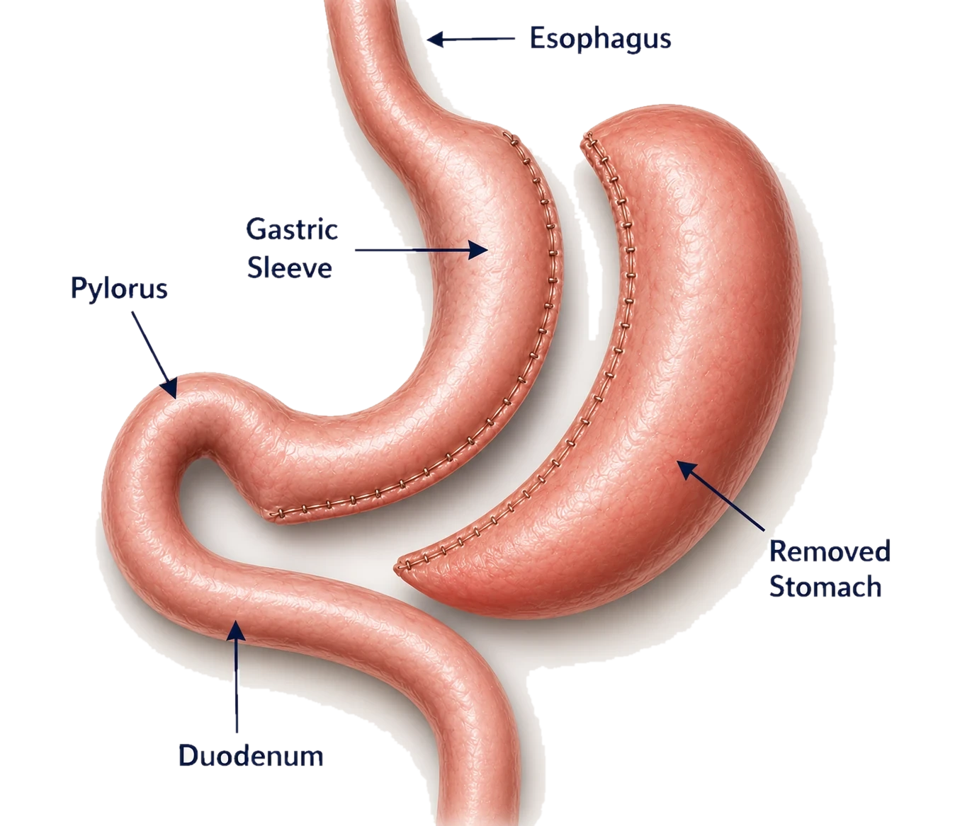 Gastric sleeve (sleeve gastrectomy) anatomy