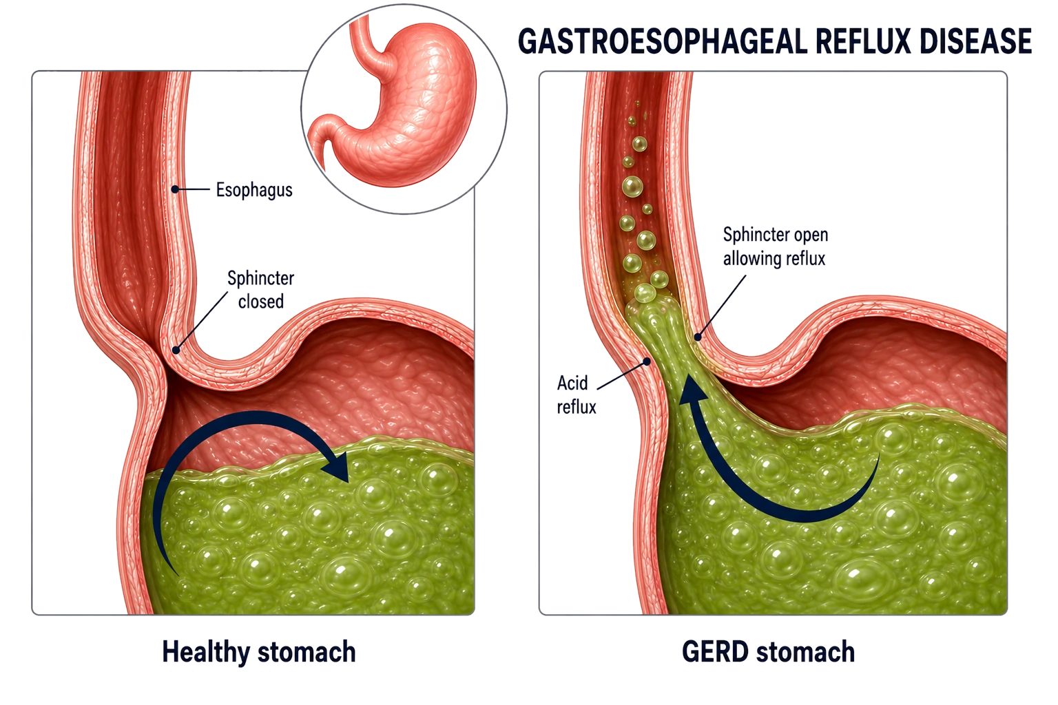 Cross-section showing stomach acid refluxing through a weakened lower esophageal sphincter into the esophagus