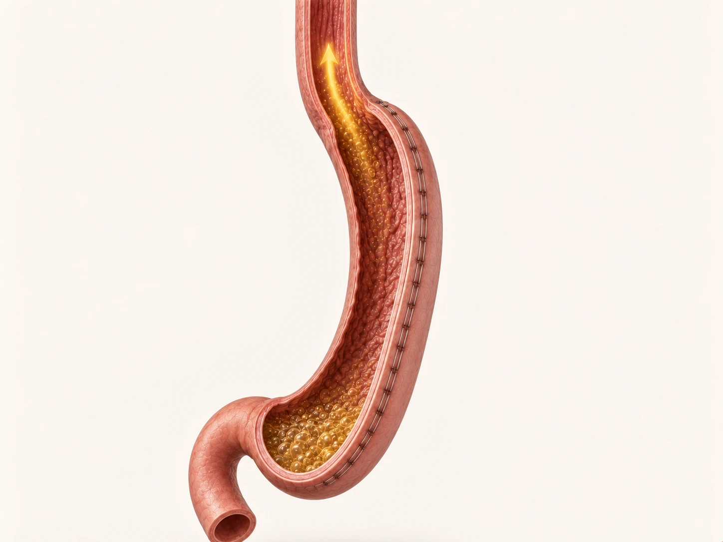Why a gastric sleeve can cause acid reflux