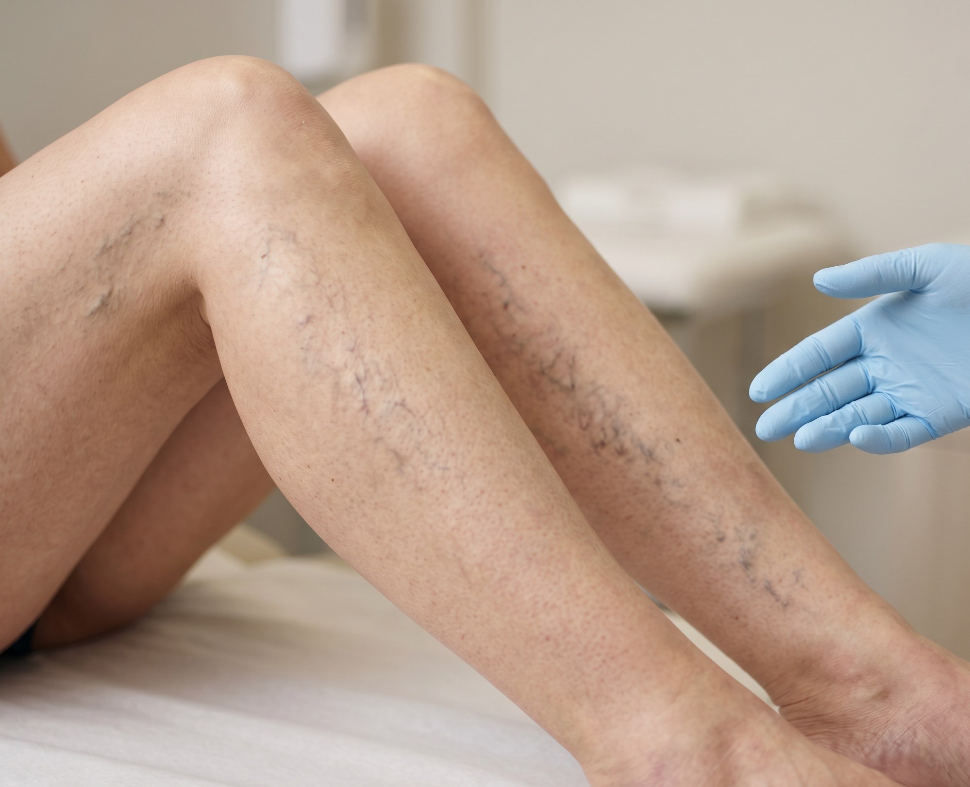 Legs with varicose and spider veins being evaluated at a vein center in Newnan, GA
