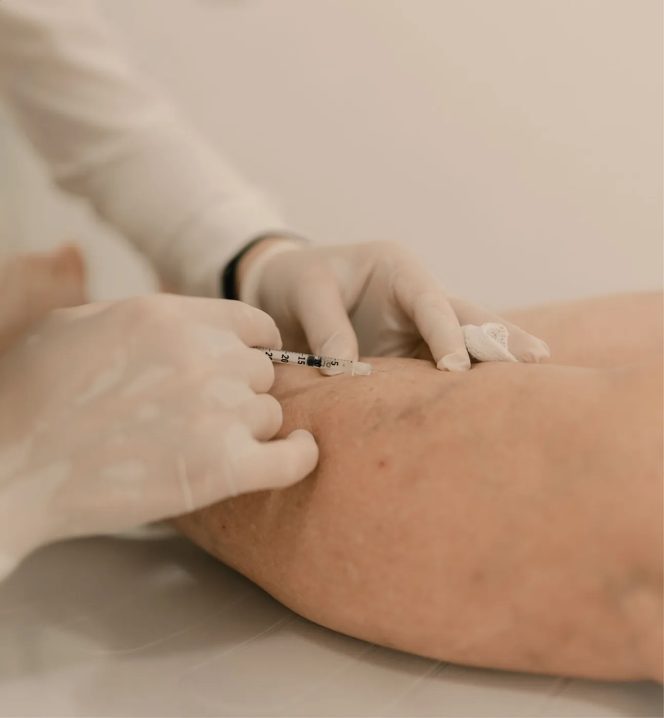 Physician injecting sclerosing solution into spider veins on a patient's leg